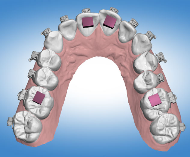 What is the Digital Indirect Bonding System 