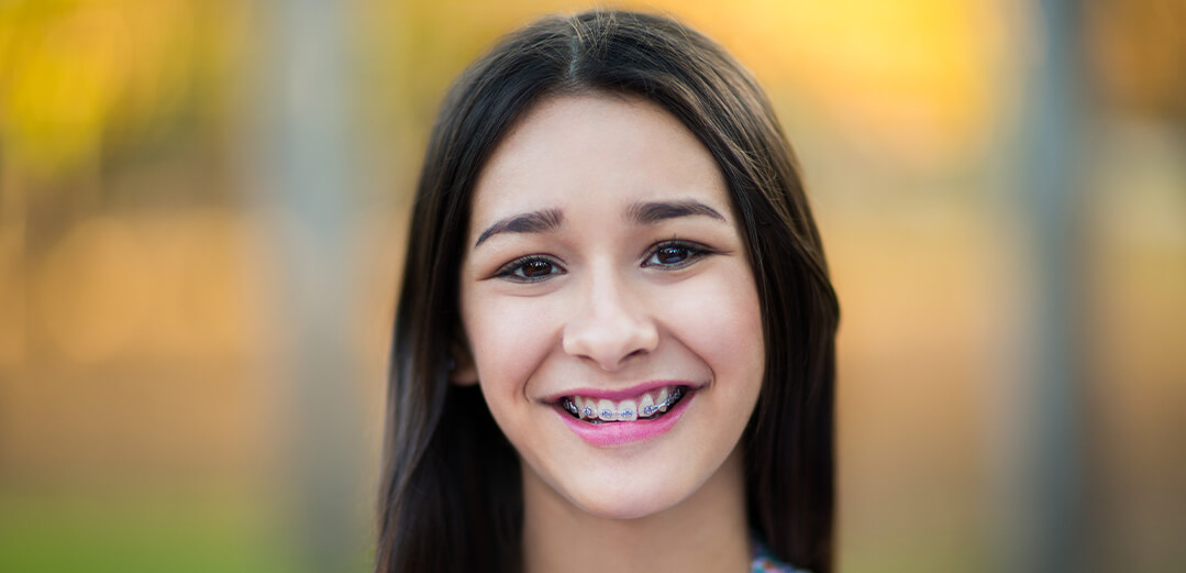 5 Important Things You Should Know Before You Get Braces