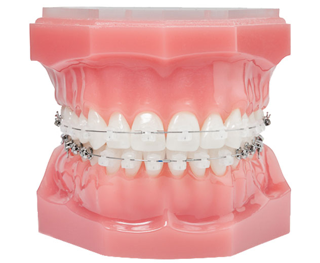 How do clear braces work