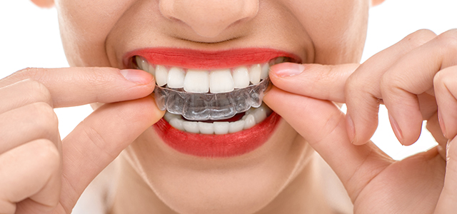 How Much Does Invisalign Cost And Is It Worth It Modern Orthodontics Blog